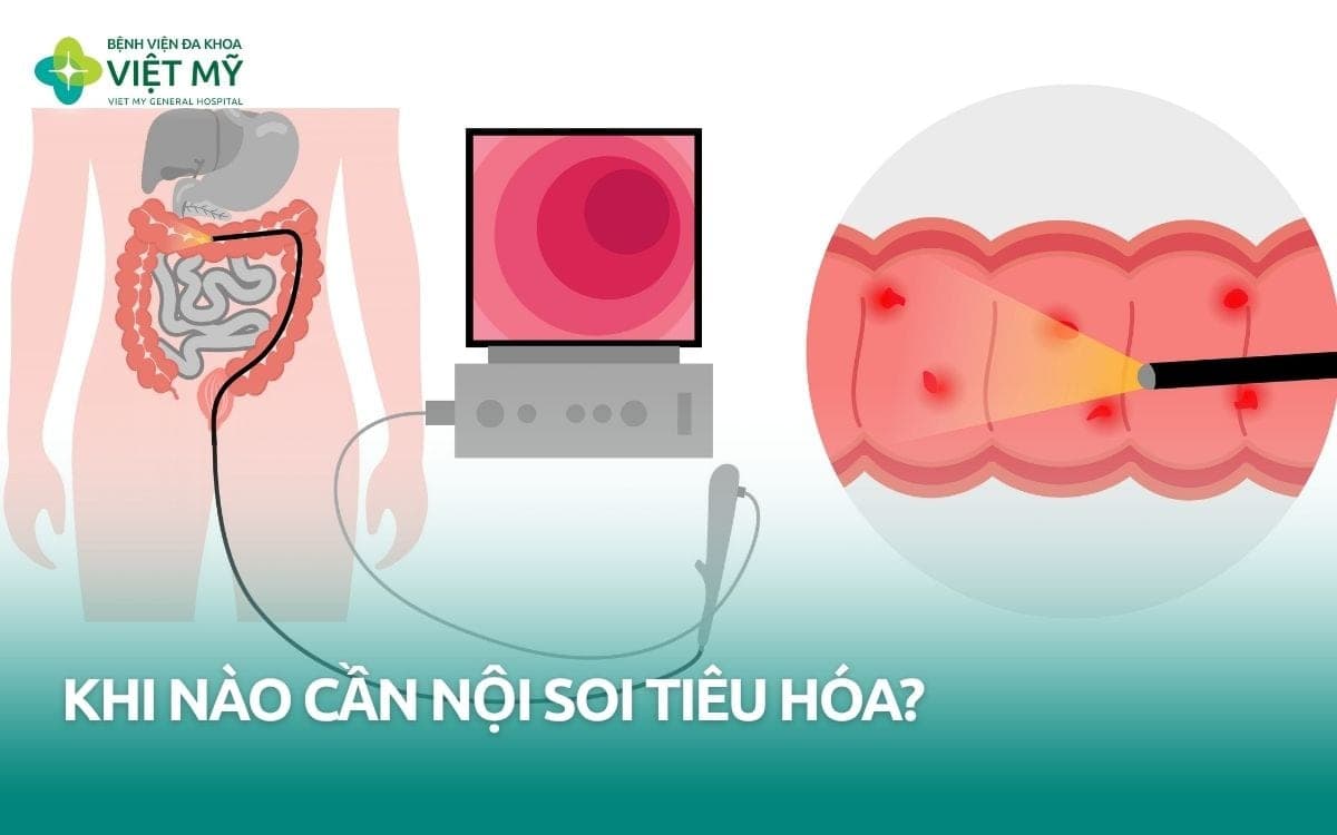 Khi nào cần nội soi tiêu hóa? Ai nên thực hiện sớm?
