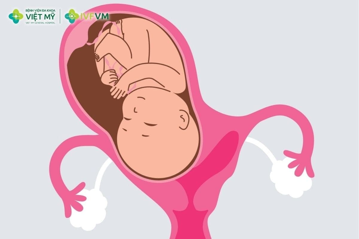 Tử cung hai sừng thường không ảnh hưởng đến khả năng thụ thai nhưng có thể làm tăng nguy cơ biến chứng thai kỳ