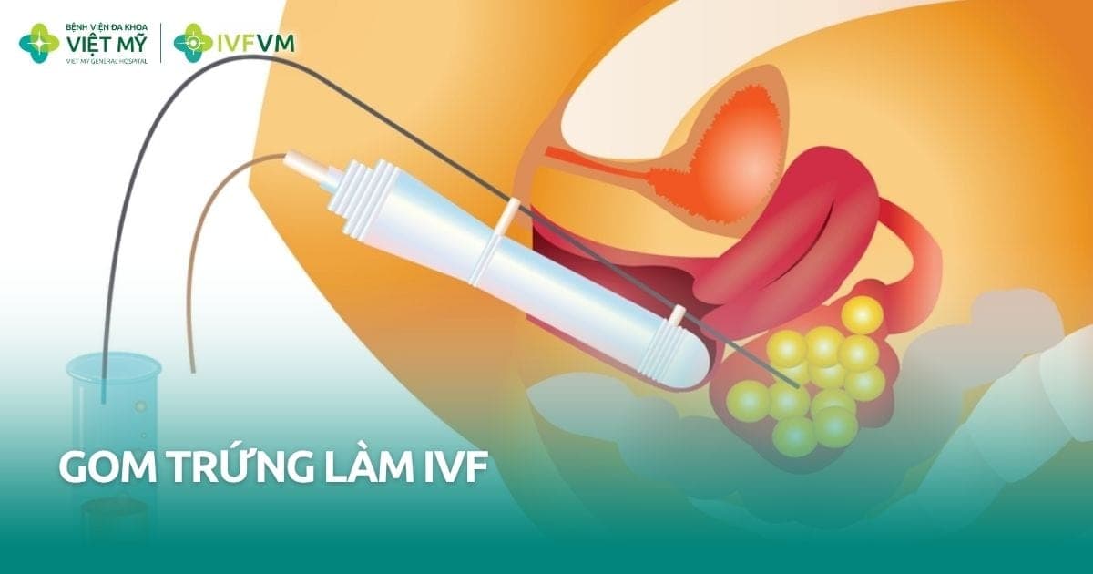 Quy trình gom trứng làm IVF như thế nào? thumb