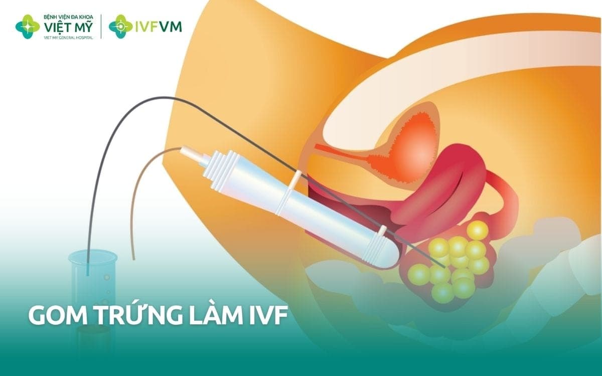 Quy trình gom trứng làm IVF như thế nào? Ưu điểm và chỉ định