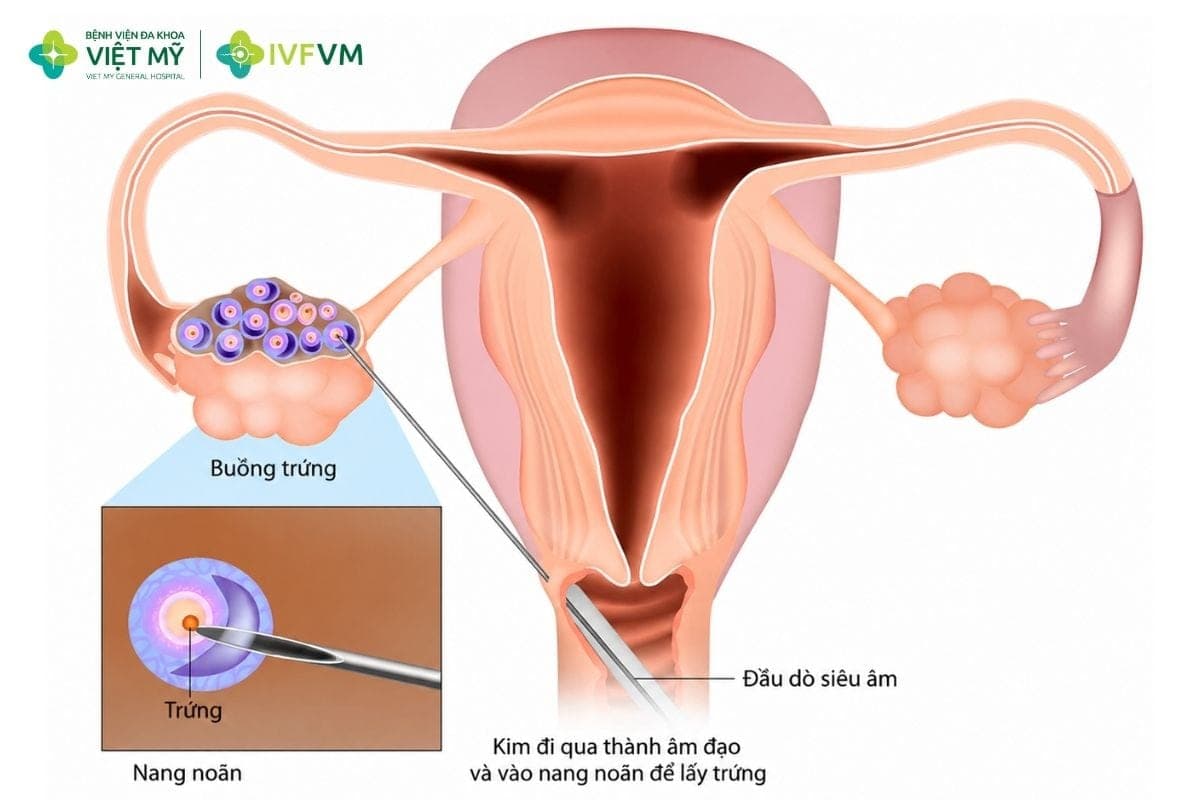 Quy trình gom trứng làm IVF gồm kích thích buồng trứng, chọc hút noãn, trữ lạnh và lặp lại qua nhiều chu kỳ cho đến khi đạt số lượng phù hợp để thụ tinh và tạo phôi