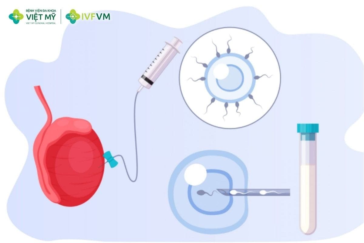 Micro-TESE giúp tìm và thu tinh trùng từ mô tinh hoàn ở nam giới vô tinh không do tắc nghẽn