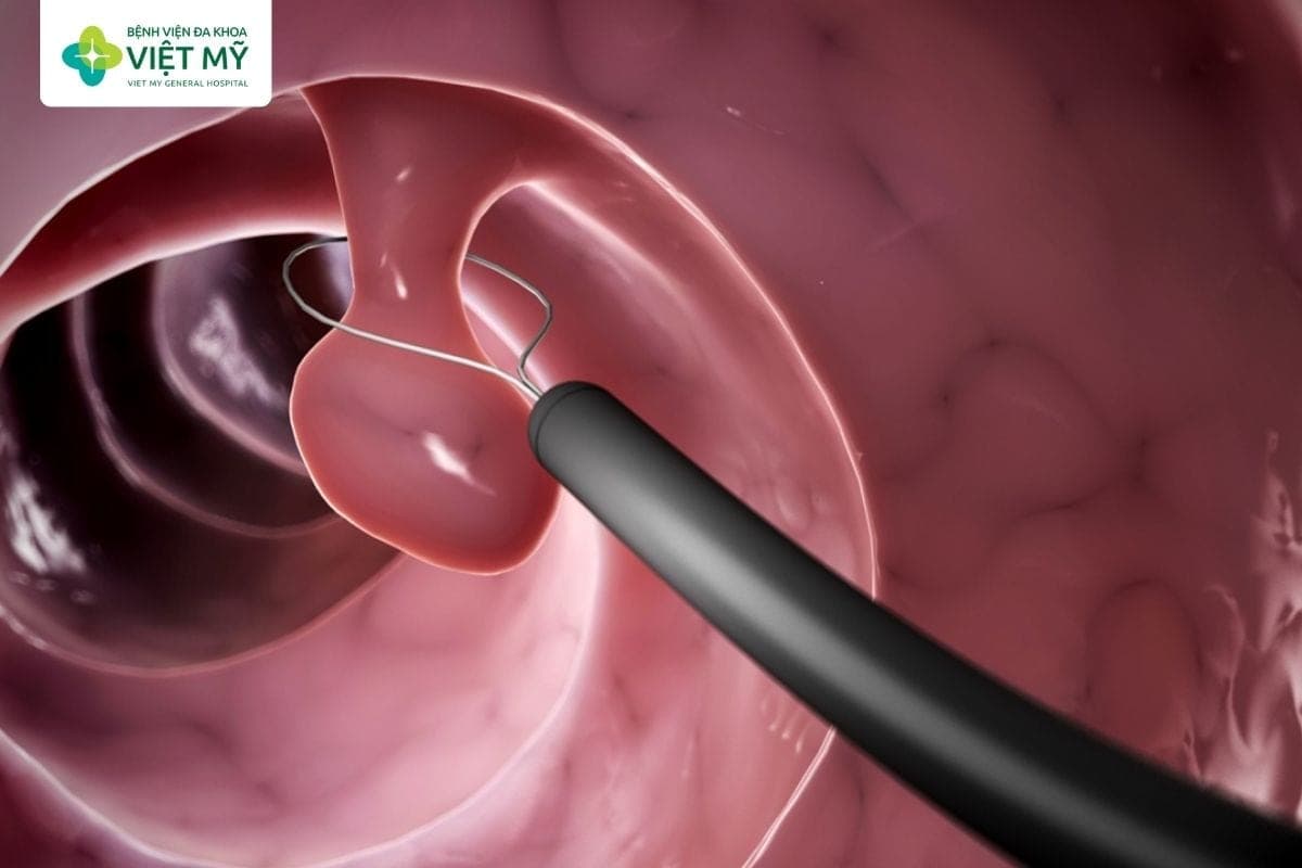 Cắt polyp qua nội soi giúp loại bỏ sớm các tổn thương có nguy cơ tiến triển thành ung thư