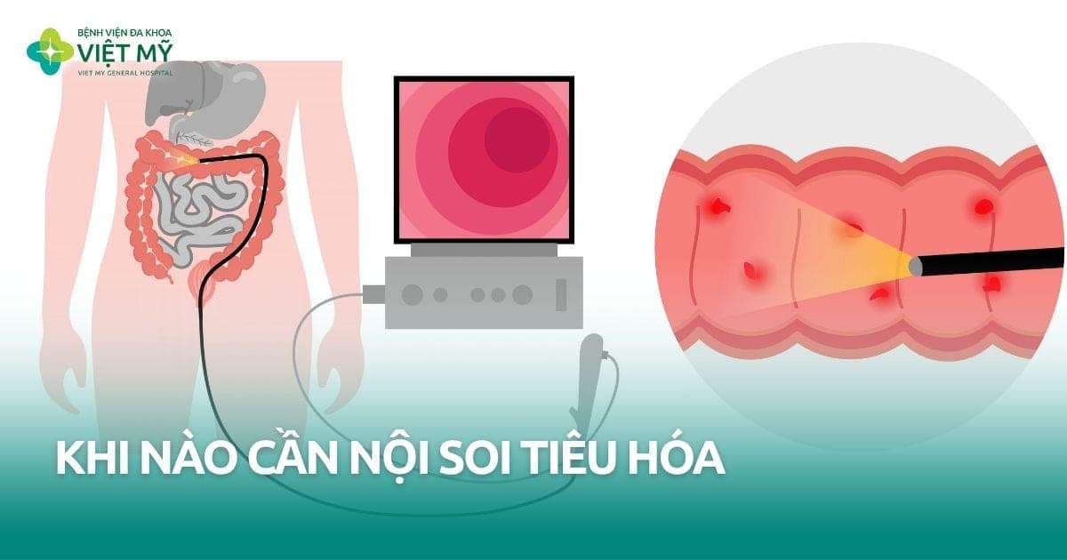 Khi nào cần nội soi tiêu hóa? thumb