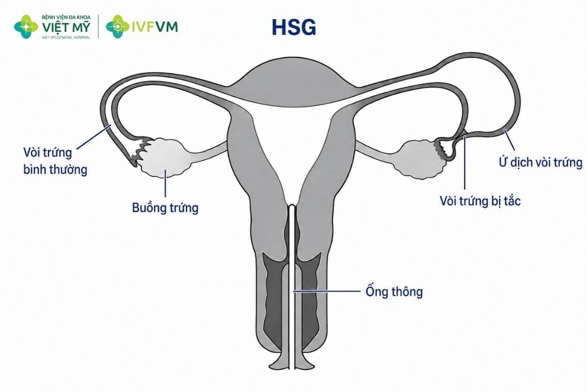 Không phải trường hợp IVF nào cũng cần thực hiện chụp HSG, tùy tình trạng và chỉ định của bác sĩ