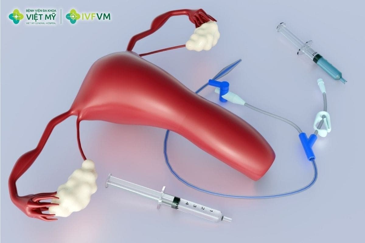 Quy trình chụp HSG gồm đặt ống thông, bơm thuốc cản quang và chụp X-quang để đánh giá buồng tử cung, vòi trứng