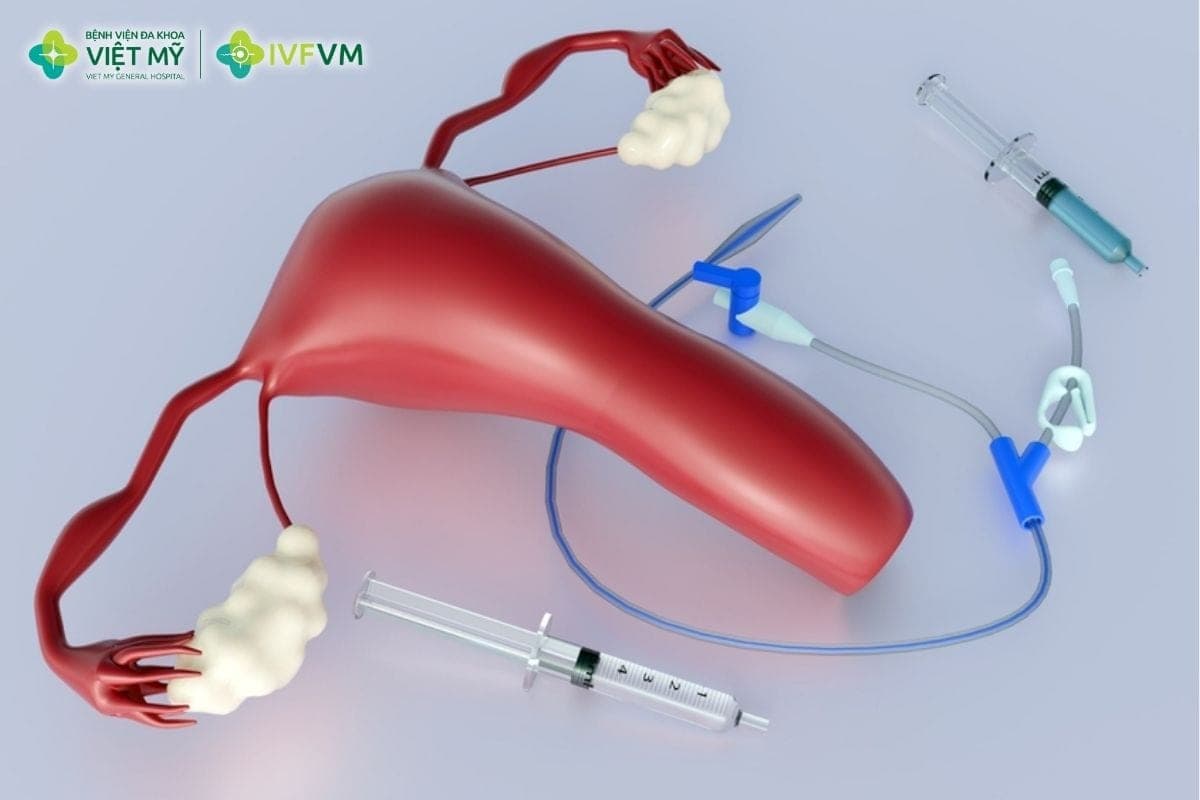 Phẫu thuật nội soi buồng tử cung tách dính giúp loại bỏ các dải mô xơ, tái lập khoang tử cung và tạo điều kiện thuận lợi hơn cho phôi làm tổ