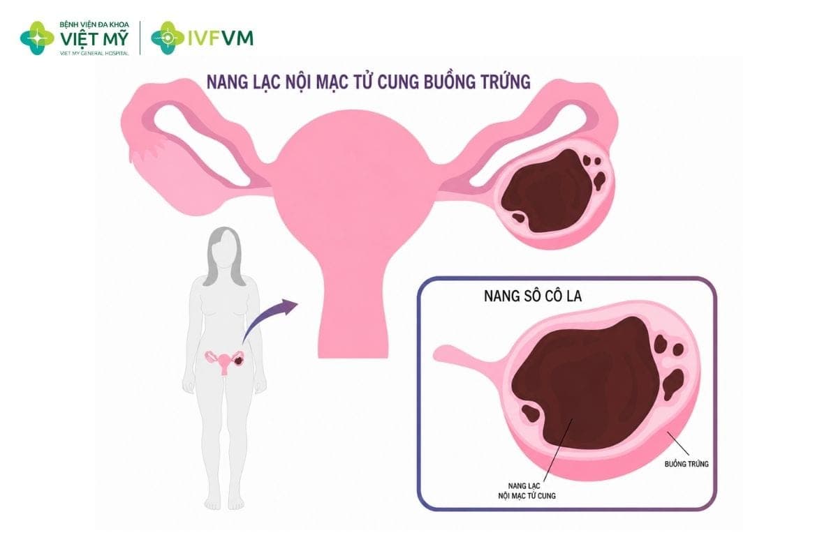 Lạc nội mạc tử cung có thể cản trở thụ thai do ảnh hưởng đến buồng trứng, vòi trứng và khả năng làm tổ của phôi