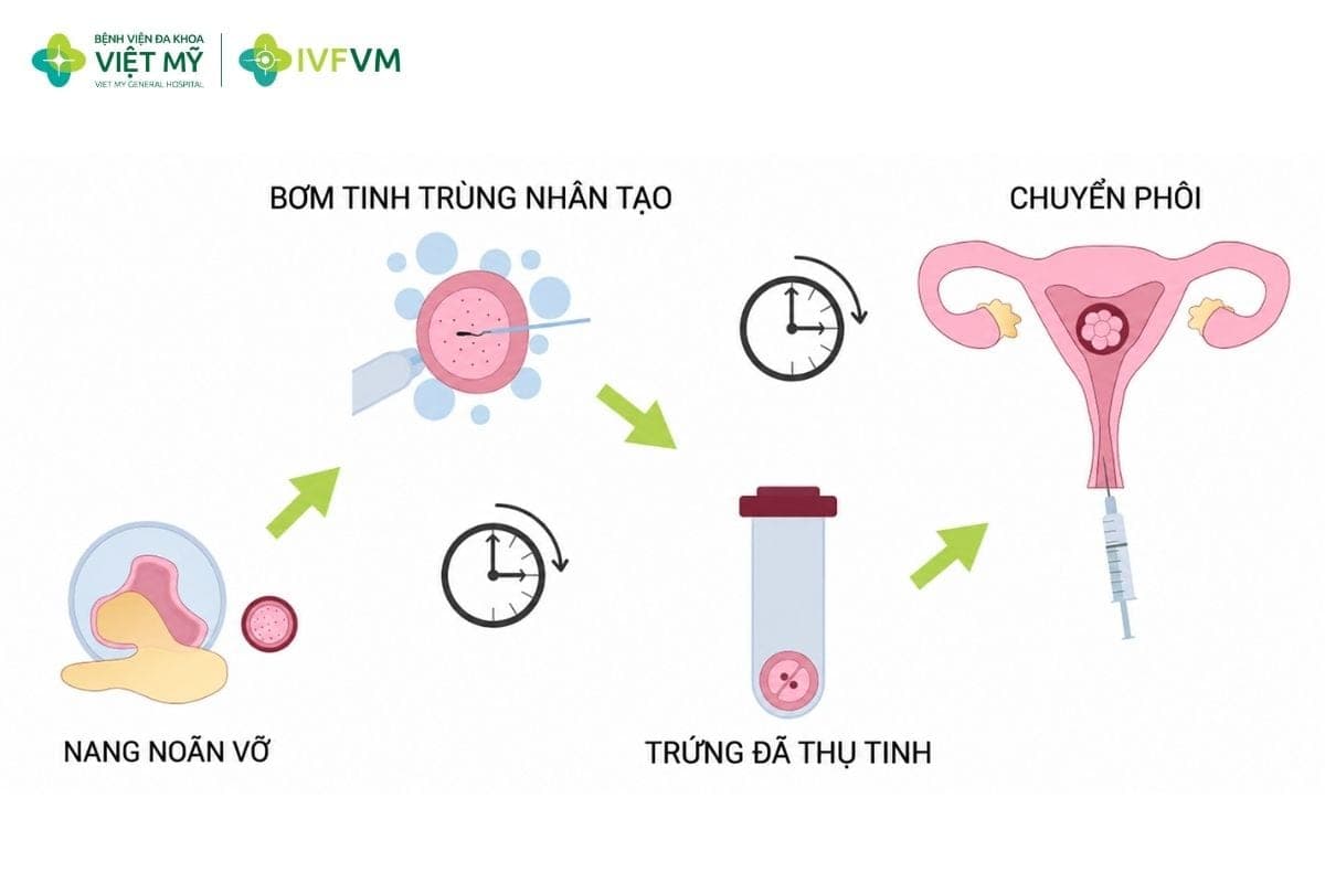 Phác đồ IVF ở người bị lạc nội mạc tử cung cần được cá thể hóa theo dự trữ buồng trứng, vị trí tổn thương và mức độ dính vùng chậu