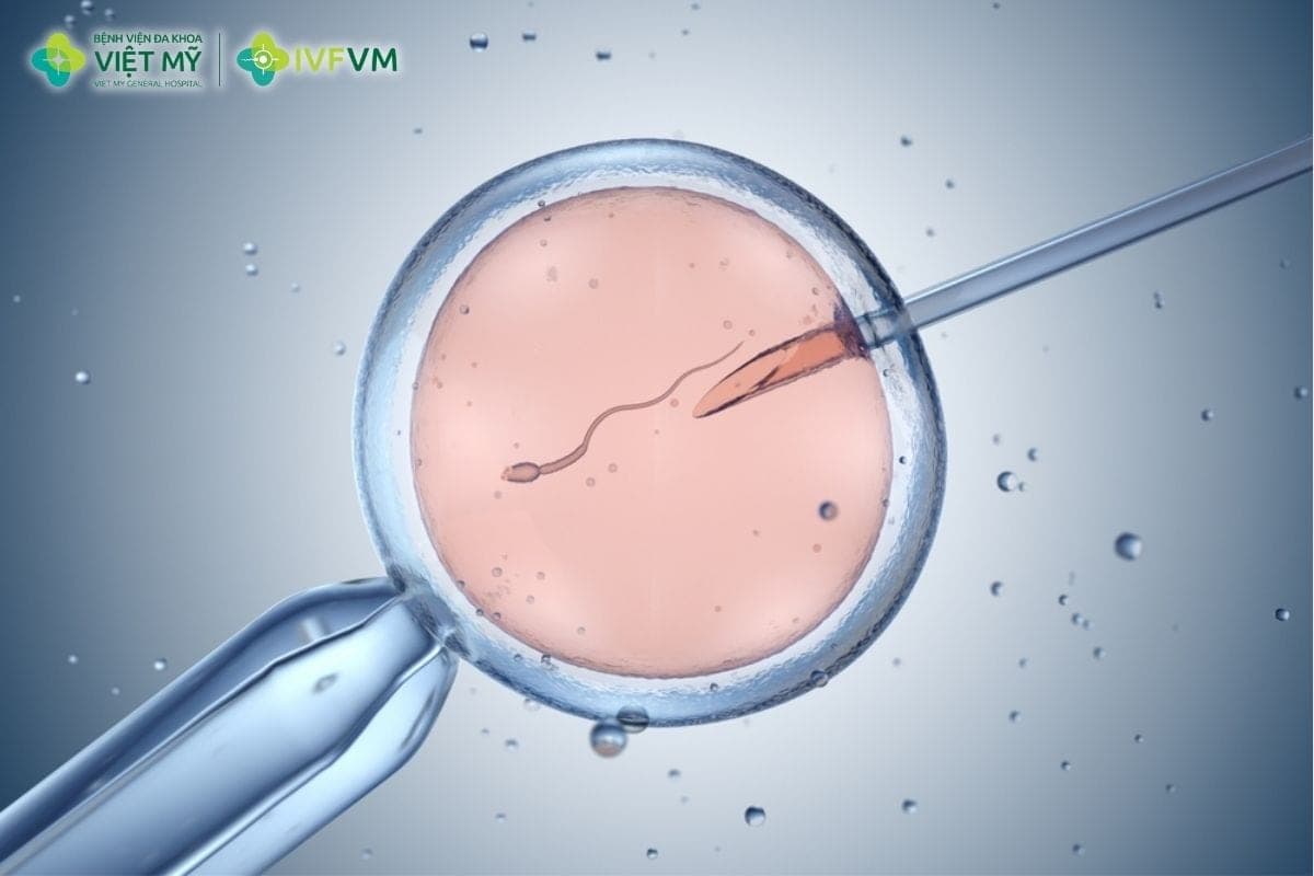 IVM là kỹ thuật lấy noãn chưa trưởng thành từ buồng trứng và nuôi trong labo đến khi đủ trưởng thành để thụ tinh