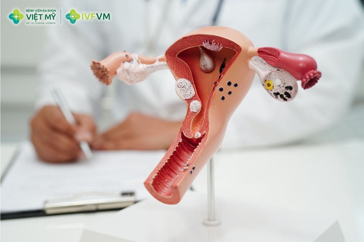 Phụ nữ bị đa nang buồng trứng vẫn có thể thực hiện IVF nếu được đánh giá và lựa chọn phác đồ phù hợp