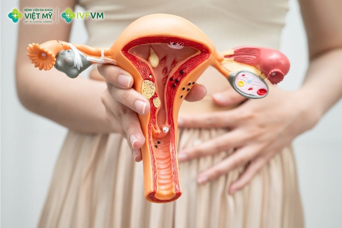PCOS có thể làm giảm khả năng thụ thai tự nhiên chủ yếu do rối loạn phóng noãn