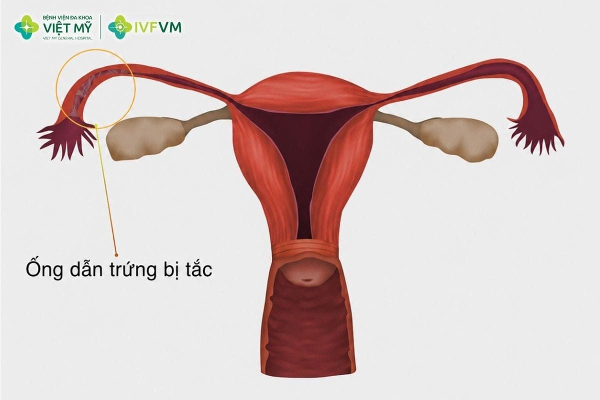 Tắc vòi trứng có thể làm giảm khả năng mang thai tự nhiên, đặc biệt khi cả hai bên đều bị tắc hoàn toàn