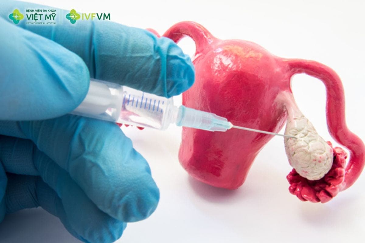 Phác đồ PPOS thường được áp dụng trong các chu kỳ IVF có kế hoạch trữ đông toàn bộ phôi thay vì chuyển phôi tươi