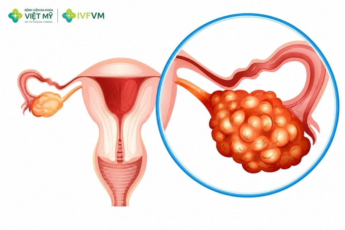 Thuốc kích rụng trứng có thể gây tác dụng phụ nhẹ hoặc làm tăng nguy cơ quá kích buồng trứng và đa thai nếu không được theo dõi sát
